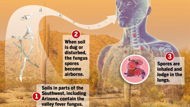 University of Arizona valley fever research seeks why some get sicker